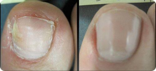 how to get rid of toenail fungus fast